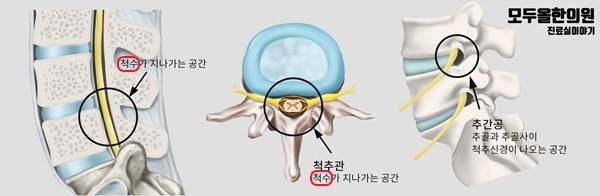 척추관협착증, 조금만 걸어도 아파서 더 못 걷겠어요.