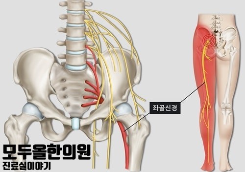 좌골신경통, 허리, 엉덩이, 허벅지가 찌릿찌릿 아파요 저려요.
