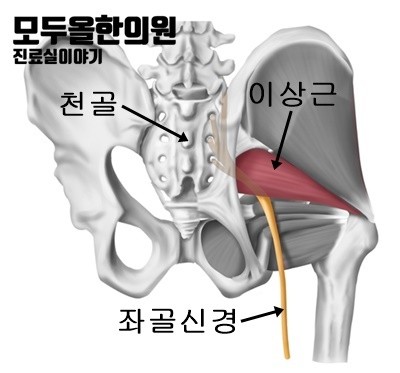 이상근증후군, 엉덩이, 허벅지가 저리면서 아파요.