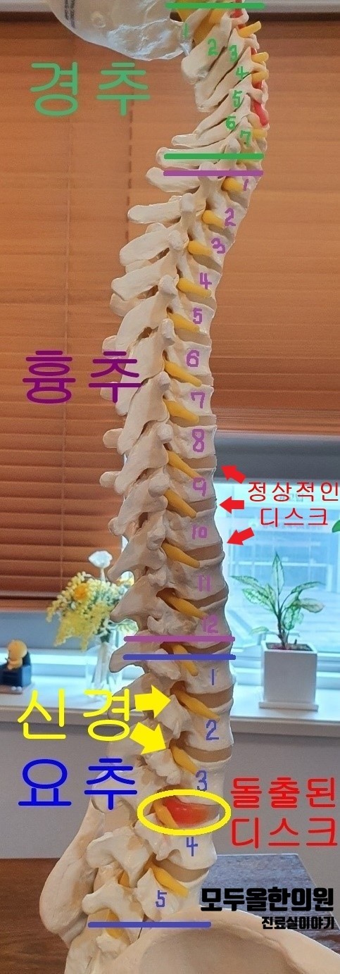 허리디스크, 허리가 아프고 다리도 저려요.